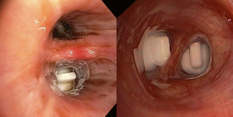 EWS in situ, dans la bonne position. EWS in situ, dans la bonne position.