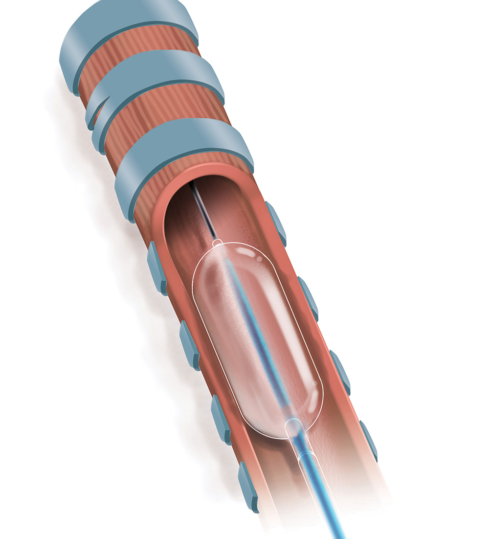 Les cathéters de dilatation traditionnels obstruent complètement les voies respiratoires. Les cathéters de dilatation traditionnels obstruent complètement les voies respiratoires.