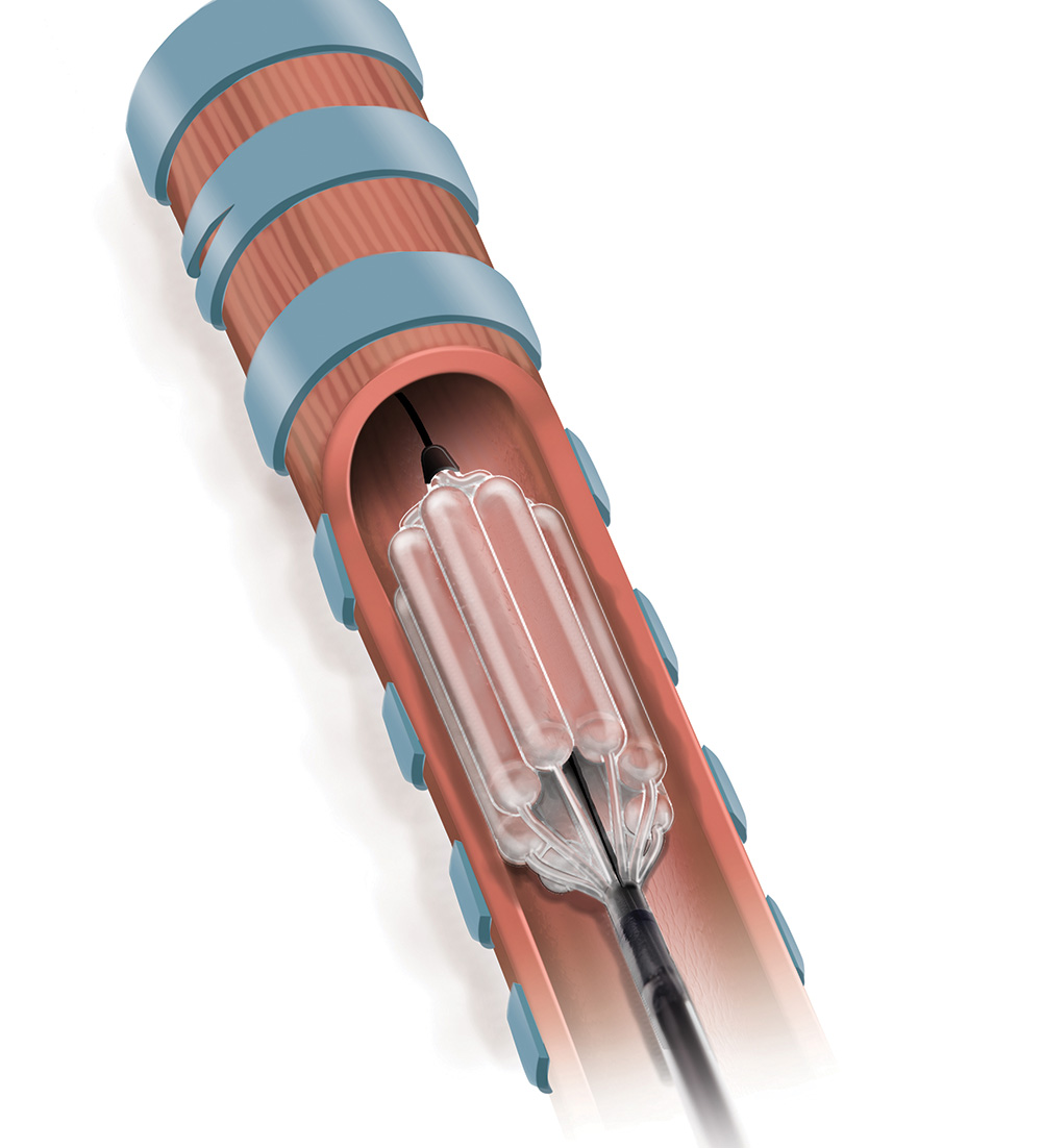 Le cathéter Trachealator permet une dilatation avec ventilation simultanée. Le cathéter Trachealator permet une dilatation avec ventilation simultanée.