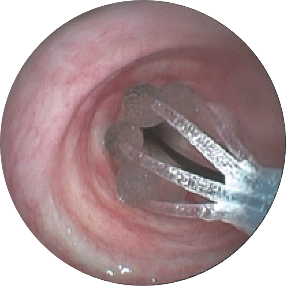 Le cathéter Trachealator in situ Le cathéter Trachealator in situ