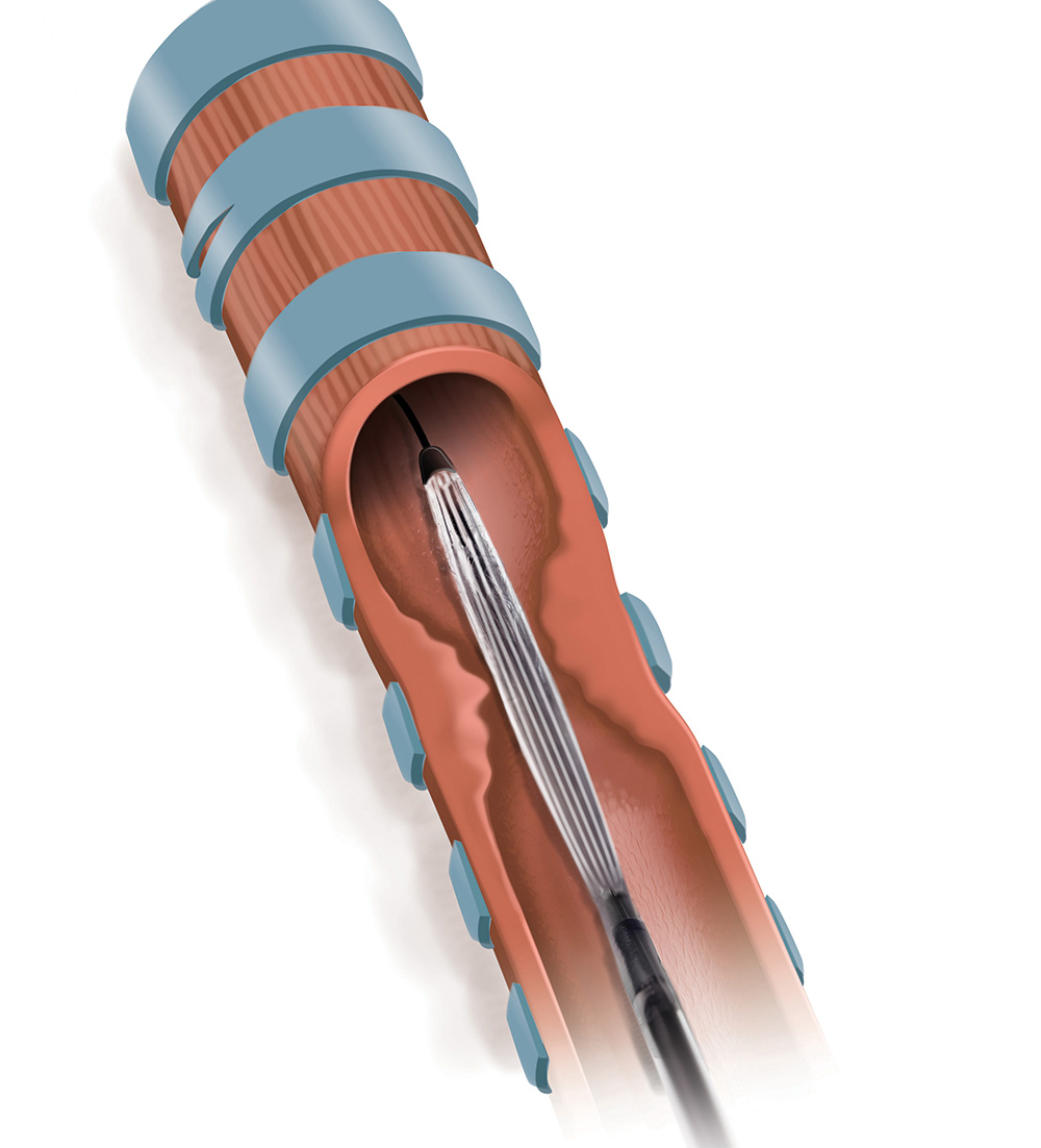 Le cathéter Trachealator est introduit à travers la sténose en position repliée. Le cathéter Trachealator est introduit à travers la sténose en position repliée.